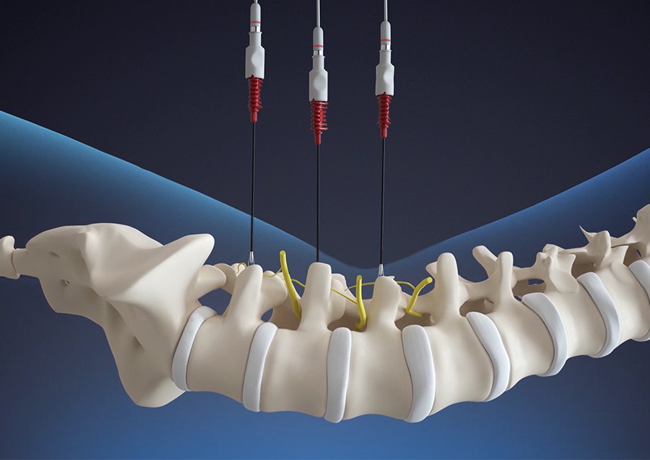 NIMBUS placement under fluoroscopy